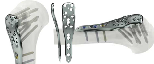 krenila locking plate