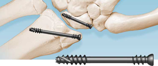 krenila ortho locking born screw