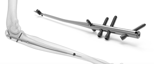 krenila ortho nail system